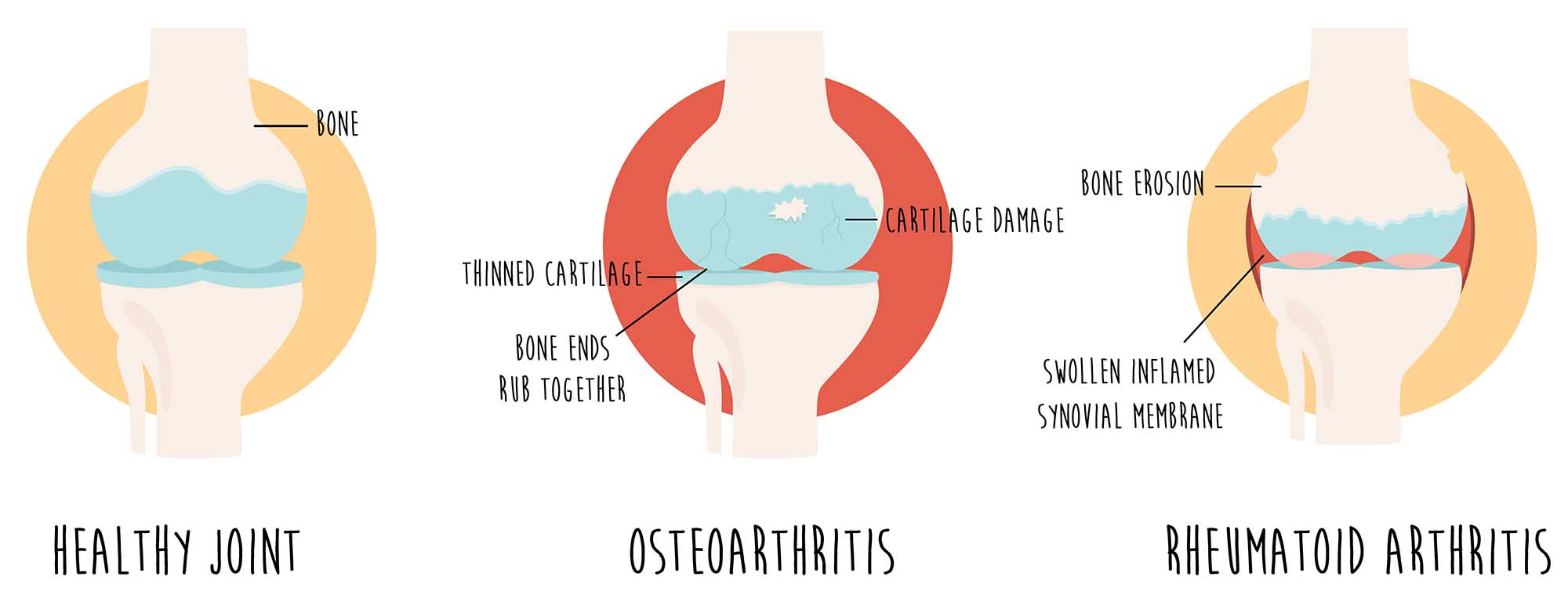 What is the difference between Osteoarthritis vs Rheumatoid Arthritis - GC Remedial Massage
